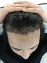 -大麦微针植发丨全国连锁