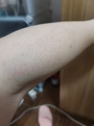 体验后-深圳春天阳光医院·轮廓抗衰中心