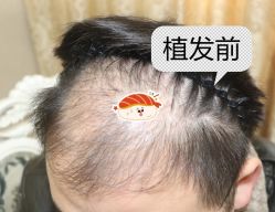 -大麦微针植发全国连锁