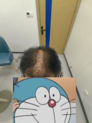 -大麦微针植发全国连锁