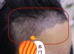 -大麦微针植发全国连锁