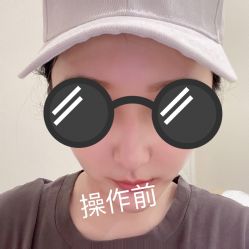 体验前-海涛医疗美容·面部抗衰·注射美鼻