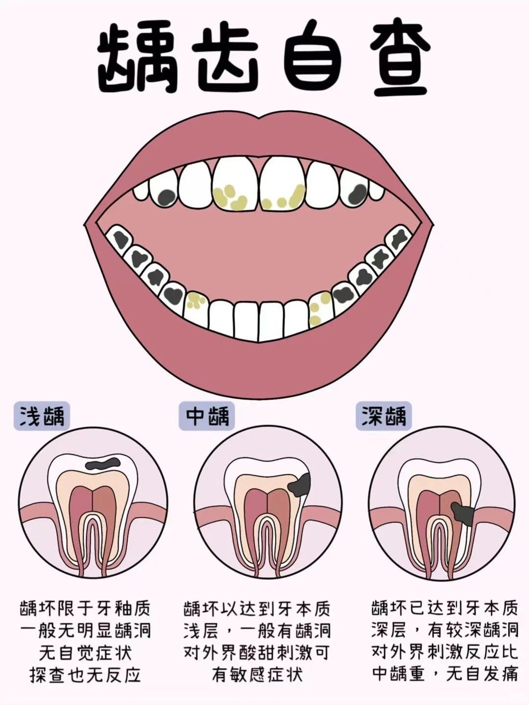 你有龋齿吗?
烂牙警告⚠#龋齿 #保