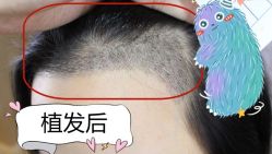 -大麦微针植发全国连锁