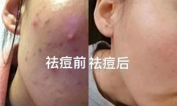 -瑶芳清颜草本祛痘
