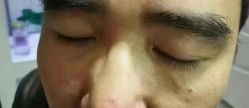 -北京美痣堂古方祛痣斑疣瘊