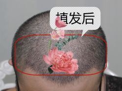 -大麦微针植发全国连锁