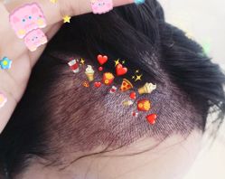 -大麦微针植发全国连锁