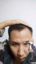 -大麦微针植发丨全国连锁