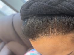 -碧莲盛·不剃发植发