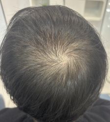 -大麦微针植发丨全国连锁