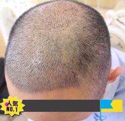 -大麦微针植发丨全国连锁