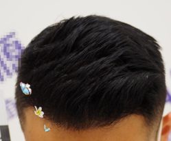 -大麦微针植发全国连锁