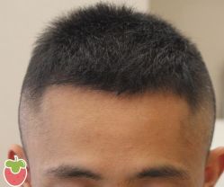 -大麦微针植发丨全国连锁