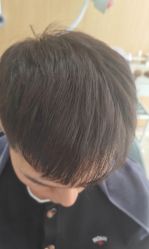 -大麦微针植发丨全国连锁