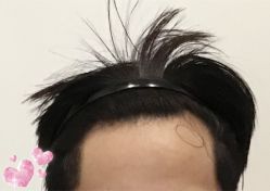 -大麦微针植发全国连锁