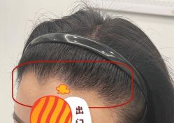 -大麦微针植发全国连锁