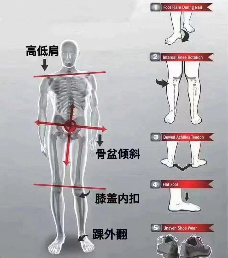 走路过度外八 膝盖内扣 踝外翻