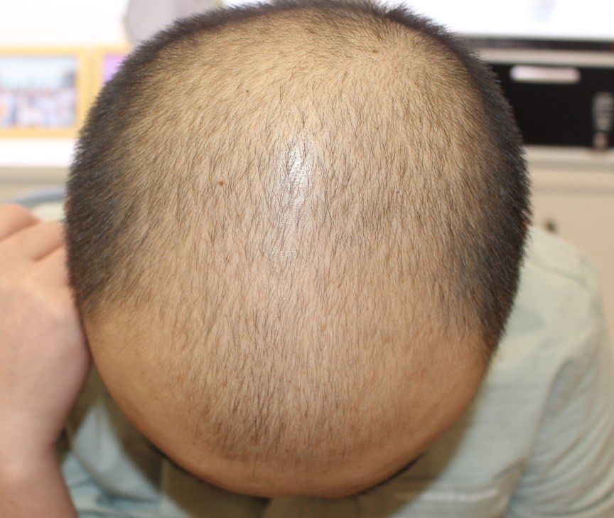 逆转脱发,重拾浓密风采!