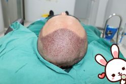 点击看大图 -大麦微针植发丨全国连锁