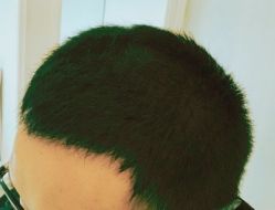 -大麦微针植发丨全国连锁