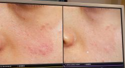-苑苑vbeauty科技美容SPA