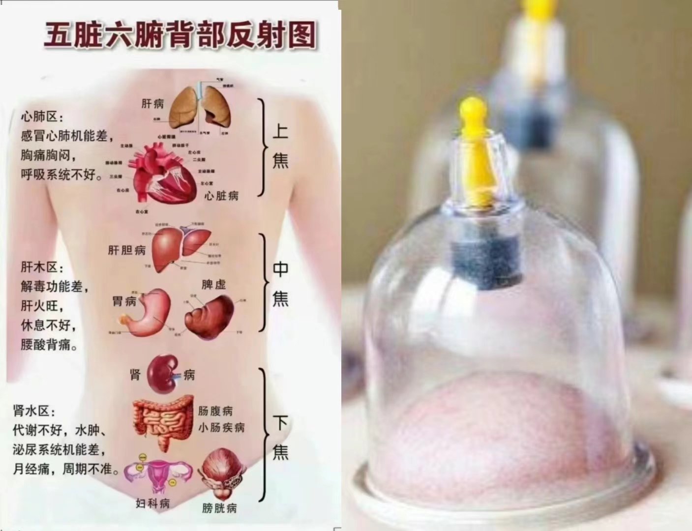 男士拔罐后背位置实图图片