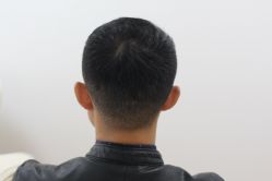 -大麦微针植发丨全国连锁