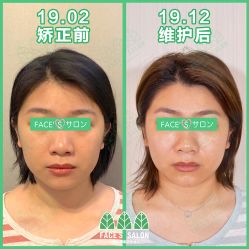 -FACE·日本小颜矫正美容整骨サロン