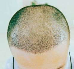 -大麦微针植发丨全国连锁