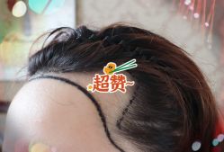 -大麦微针植发全国连锁