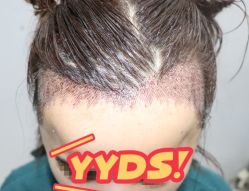 -大麦微针植发丨全国连锁