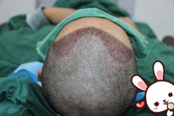 点击看大图 -大麦微针植发丨全国连锁