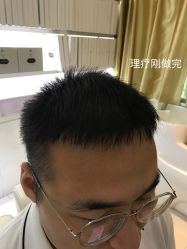 点击看大图 -大麦微针植发全国连锁