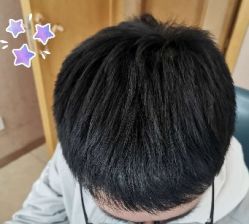 -大麦微针植发丨全国连锁