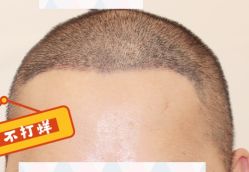 -大麦微针植发全国连锁