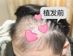 -大麦微针植发全国连锁