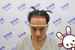 -大麦微针植发丨全国连锁