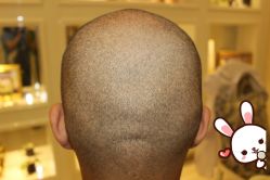 点击看大图 -大麦微针植发丨全国连锁