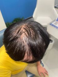 点击看大图 体验前-大麦微针植发全国连锁