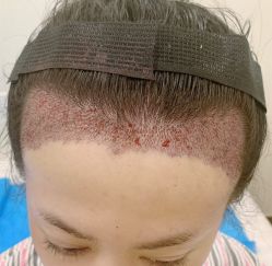 -碧莲盛·不剃发植发
