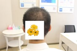 -大麦微针植发丨全国连锁