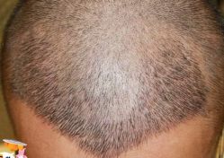 -大麦微针植发丨全国连锁