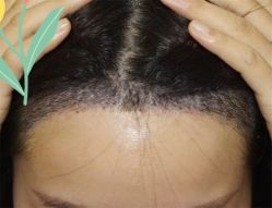 点击看大图 -大麦微针植发全国连锁