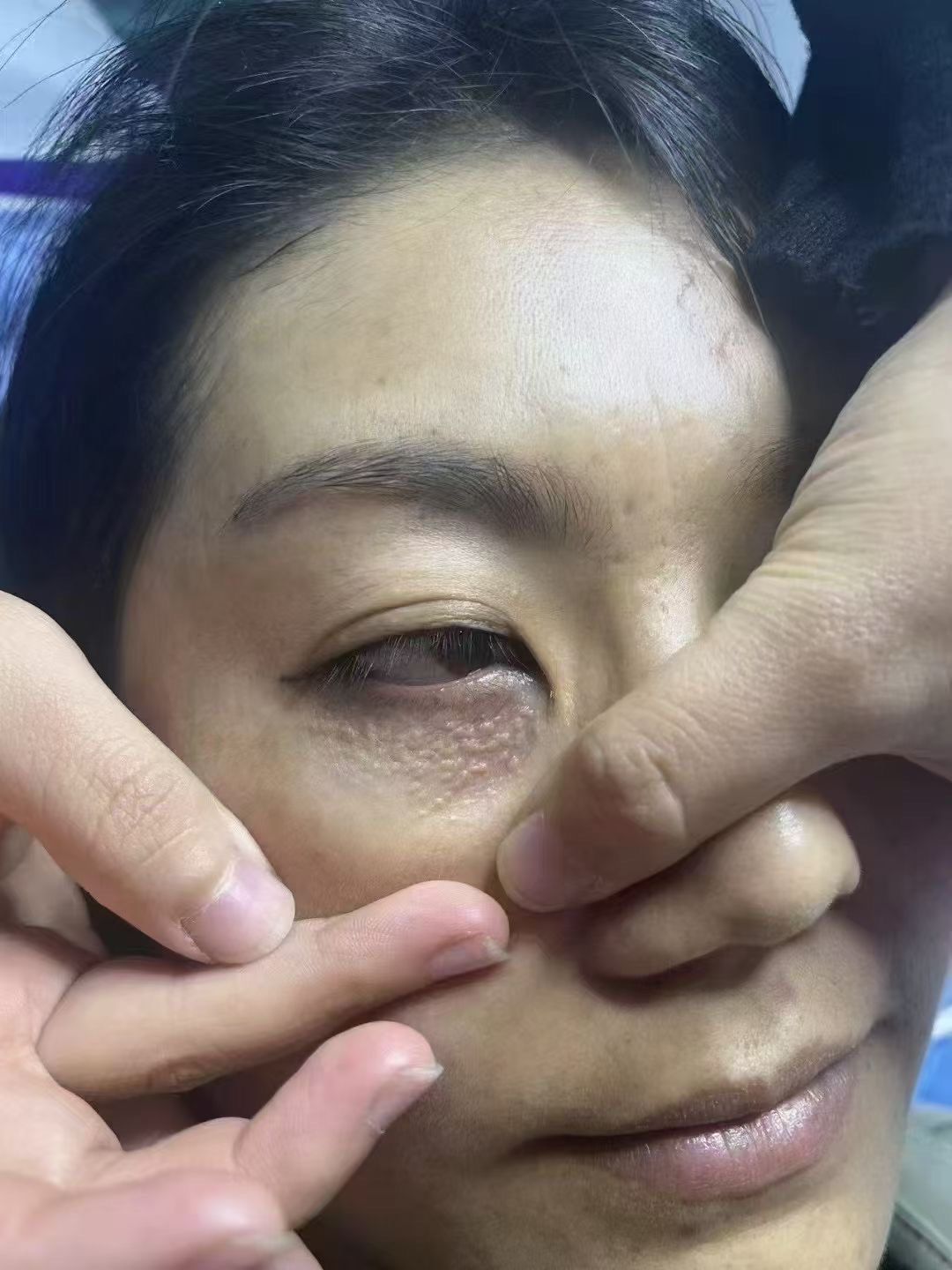 汗管瘤化妆技术再好\n粉盖🉐再厚,也