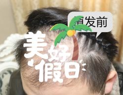 -大麦微针植发全国连锁