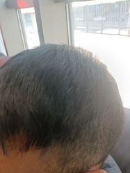 -碧莲盛·不剃发植发