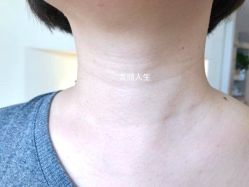 -爱莎扁平疣·汗管瘤·斑痣中心