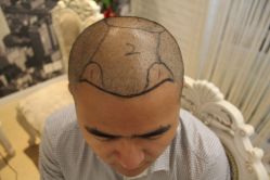 点击看大图 -大麦微针植发丨全国连锁