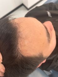 -大麦微针植发全国连锁